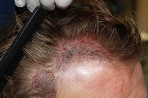 Michael Gray hair transplant close-up